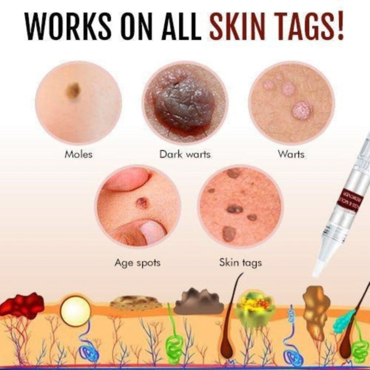 Unisex natural skin tag & mole remover featuring tea tree oil & borneol for smooth, clear skin. Organic blemish treatment.